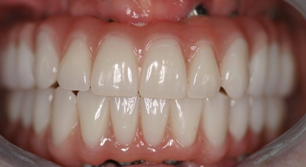 Full-arch implant after photo - Case 1