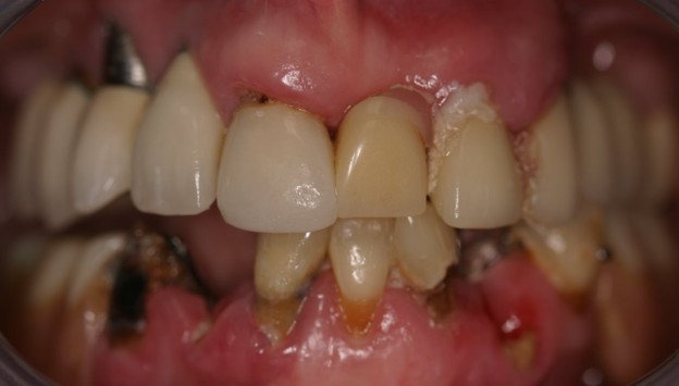 Full-arch implant before photo - Case 1