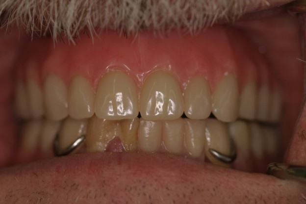 Full-arch implant after photo - Case 2