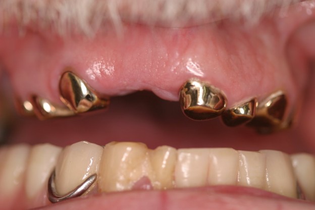 Full-arch implant before photo - Case 2