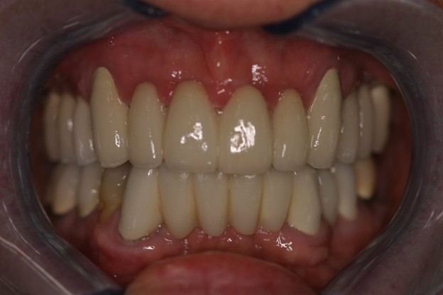 Full-arch implant after photo - Case 3
