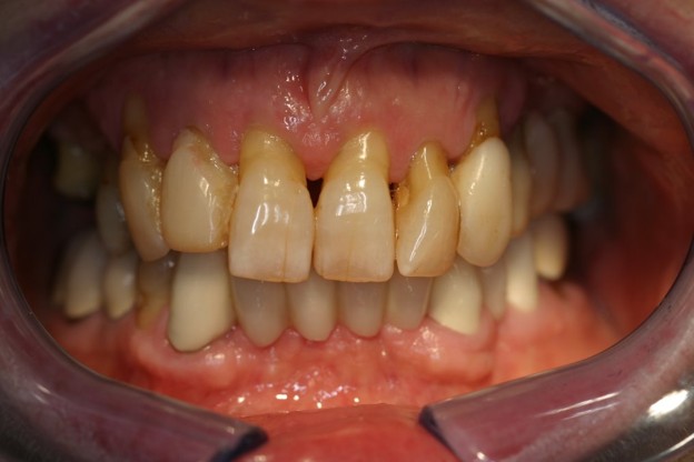 Full-arch implant before photo - Case 3