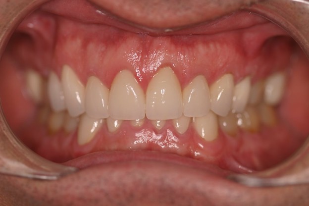 Full-arch implant after photo - Case 4