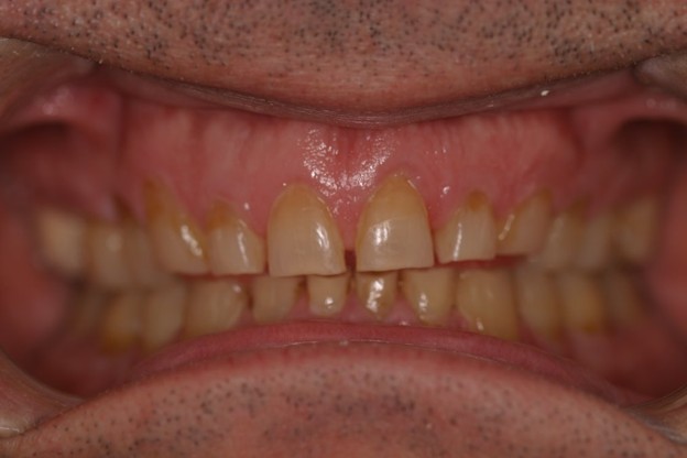 Full-arch implant before photo - Case 4